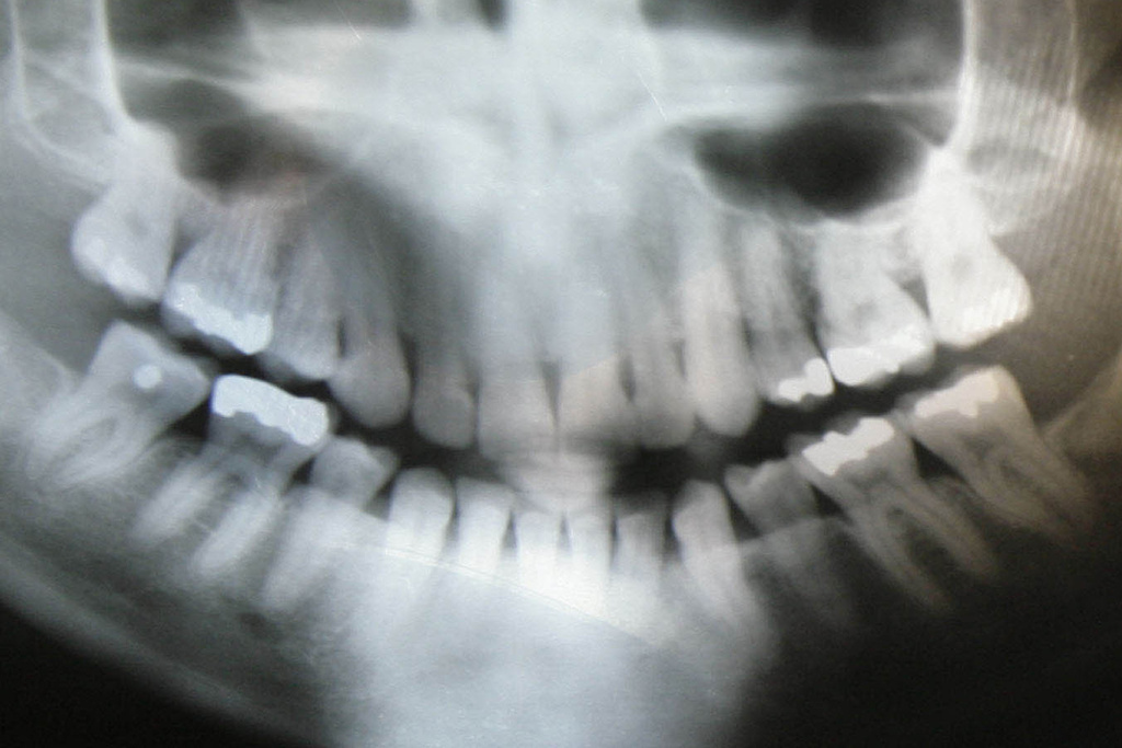 dental x ray lead apron
