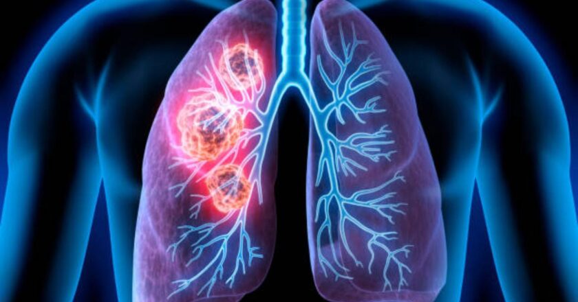 Here`s why most lung cancer patients in India are non-smokers