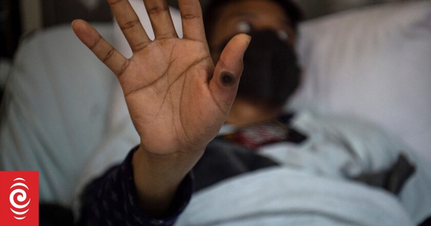 First case of more dangerous mpox found outside Africa