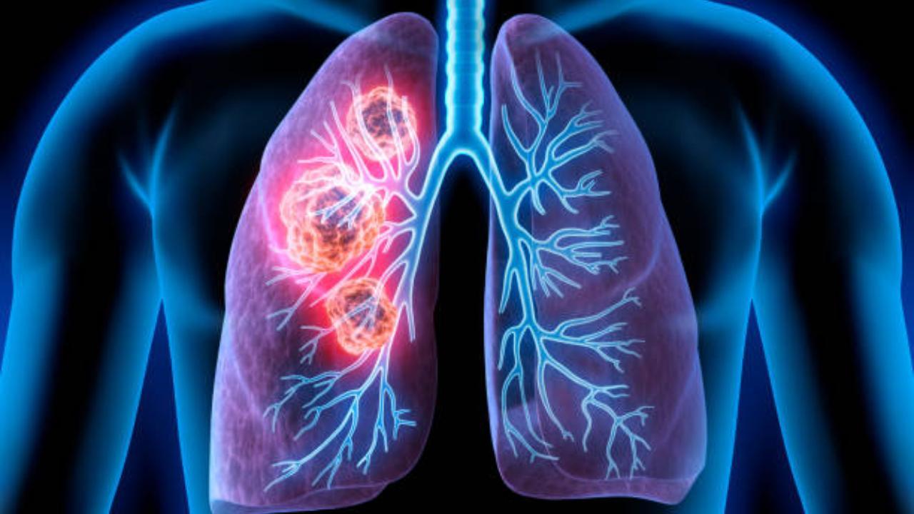 Lung cancer is most common cancer to spread to brain