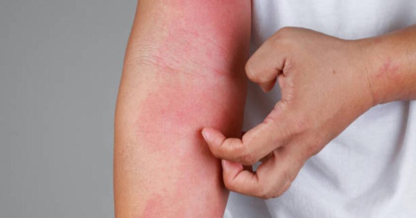 Psoriasis is more likely to affect men, say experts