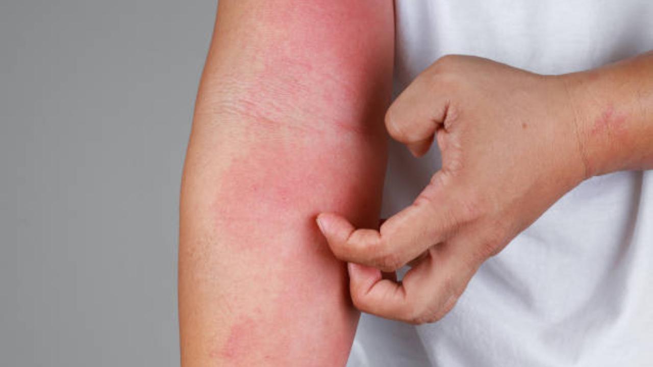 Psoriasis is more likely to affect men say