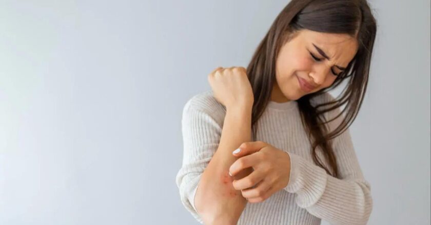 10-20 per cent women may experience psoriasis during pregnancy, finds study
