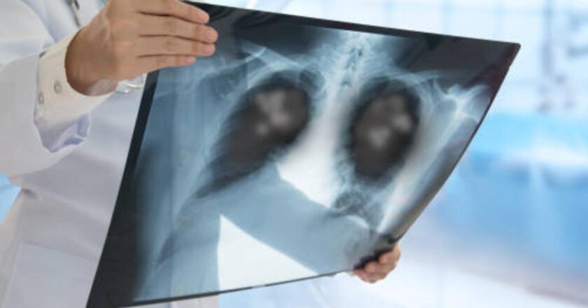 Lung cancer rising among non-smokers in India; doctors raise concern