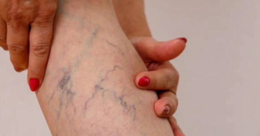 Ice-cold feet and heaviness in legs may signal varicose veins: Study