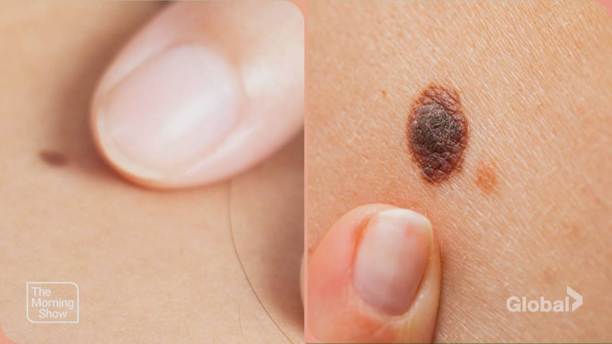 Click to play video: 'Winter sun safety: Why you need year-round protection'