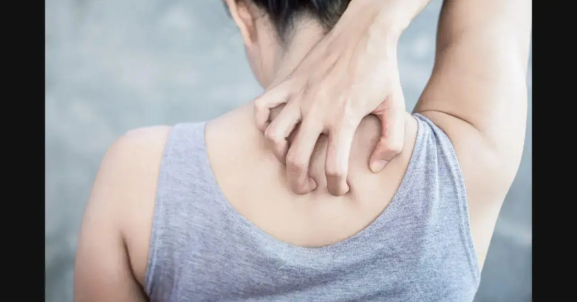 Belly fat may raise risk of psoriasis in women, finds study