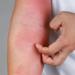 Psoriasis patients may be at risk of obesity, fatty liver disease: Study