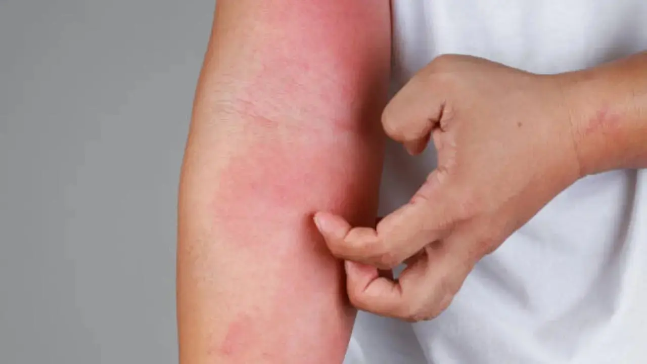 Psoriasis patients may be at risk of obesity fatty liver