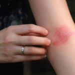 Early exposure to pet dogs may lower kids` risk of eczema: Study
