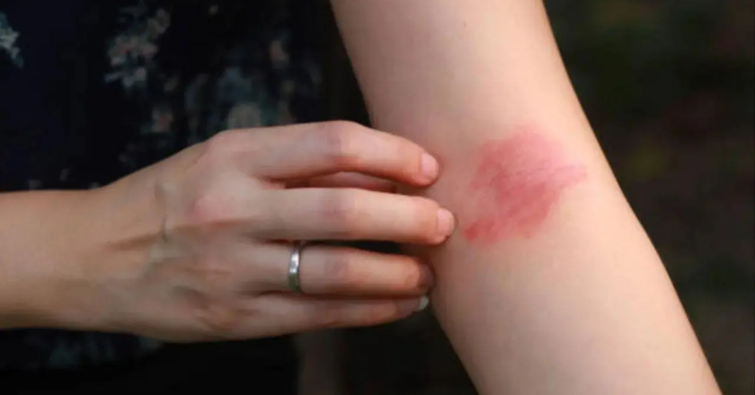 Early exposure to pet dogs may lower kids` risk of eczema: Study