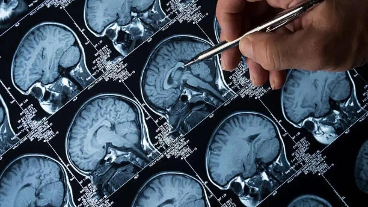UK researchers discover eight new schizophrenia genes