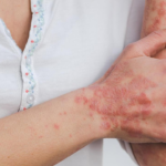 World Psoriasis Month: Dermatologists share a guide on how to manage it better