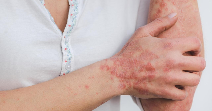World Psoriasis Month: Dermatologists share a guide on how to manage it better