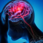 Strokes are one of the top five causes of death in India, say experts