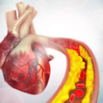 Australia leads first trial of gene editing therapy to halve bad cholesterol