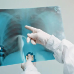 WHO praises India’s progress in reducing TB detection gaps, and mortality rate