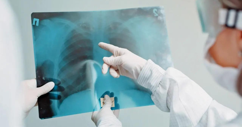 WHO praises India’s progress in reducing TB detection gaps, and mortality rate