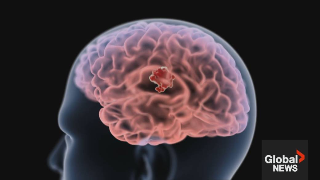 Click to play video: 'Canadian scientists uncover hidden cells fueling brain cancer – and a drug that could stop them'