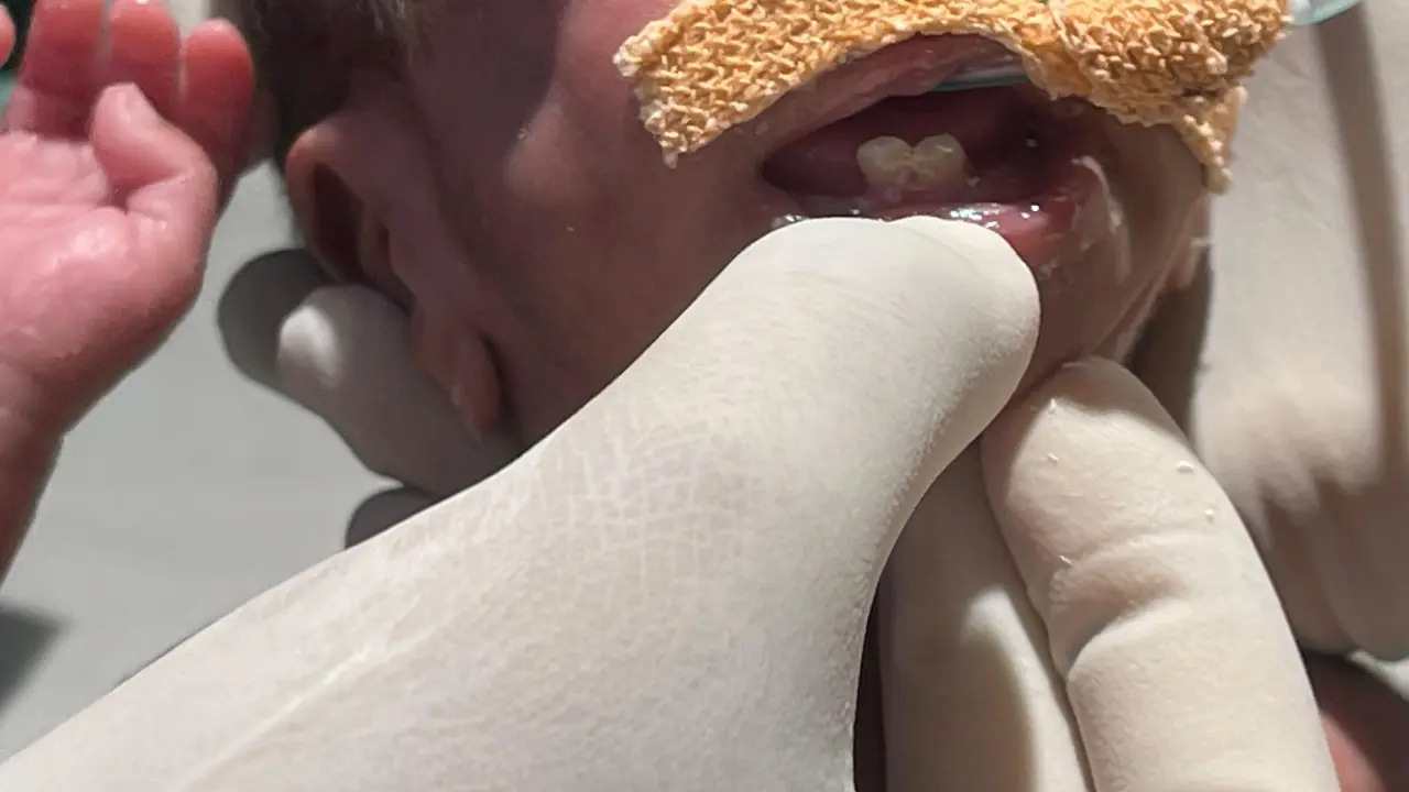 Rare natal teeth safely removed from 119 kg premature newborn