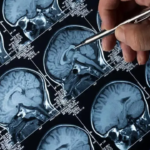 Mumbai docs find woman suffering from repeated headache had rare brain infection