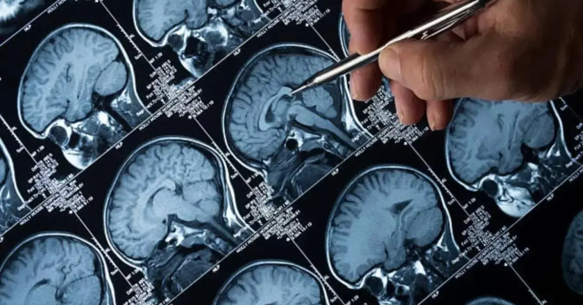 Mumbai docs find woman suffering from repeated headache had rare brain infection