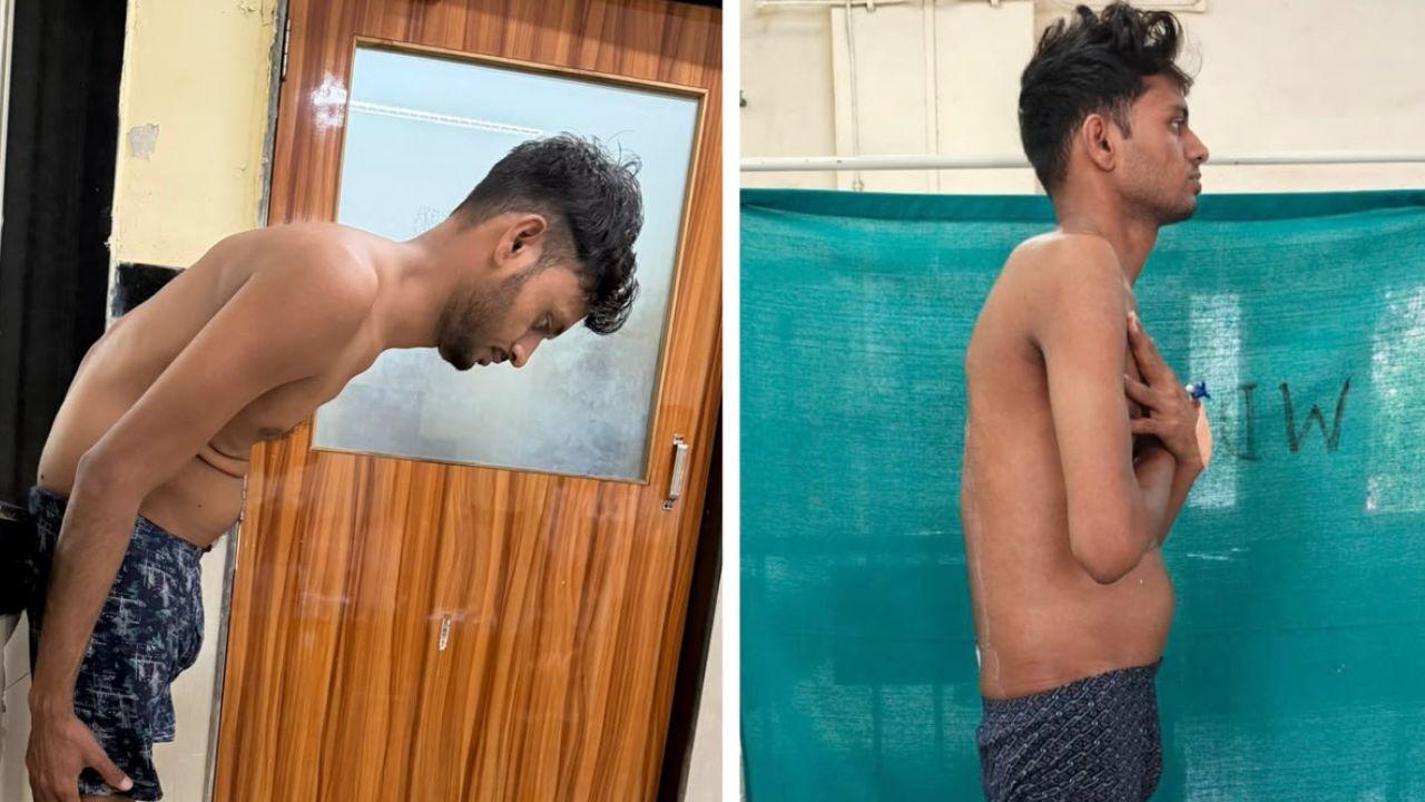 Mumbai doctors correct six year spinal deformity in rare surgery on