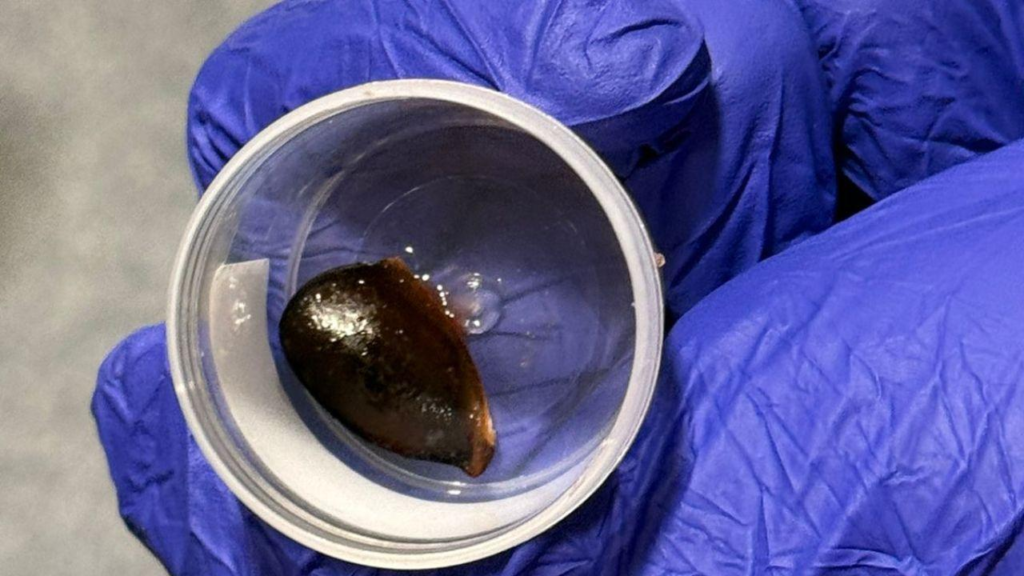 Navi Mumbai: Chikoo seed stuck in man’s lung for 3 months, removed