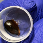Navi Mumbai: Chikoo seed stuck in man’s lung for 3 months, removed