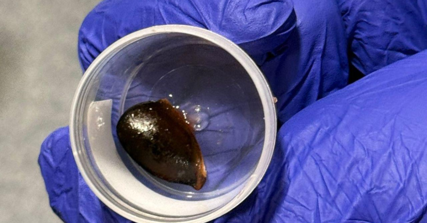 Navi Mumbai: Chikoo seed stuck in man’s lung for 3 months, removed