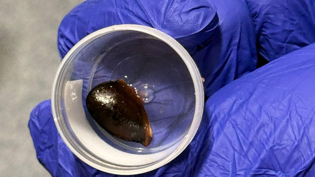 Navi Mumbai: Chikoo seed stuck in man’s lung for 3 months, removed 2 Navi Mumbai Chikoo seed stuck in mans lung for 3